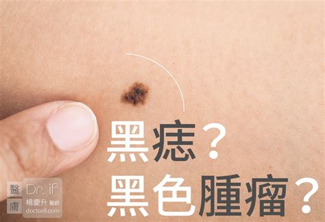 身體長黑痣|痣是什麼？會變成黑色素瘤？7種一定要除的痣